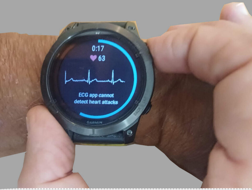 ECG