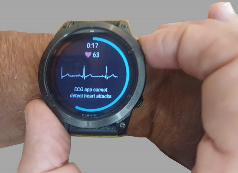 ECG